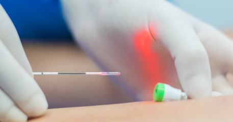 Imagem sobre a aplicação de varizes com laser