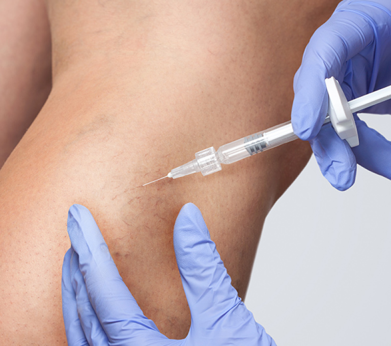 Foto de uma escleroterapia com espuma