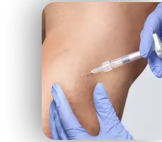 Foto de uma escleroterapia com espuma